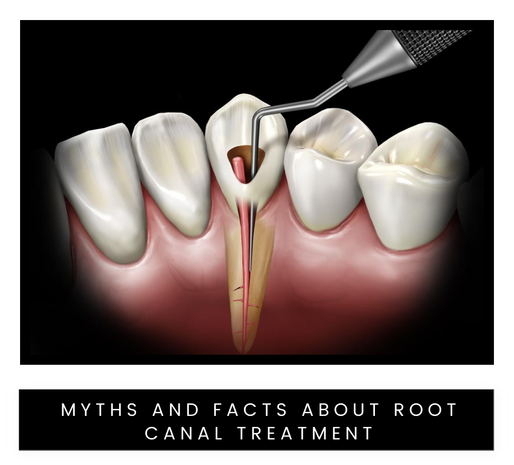 MYTHS AND FACTS ABOUT ROOT CANAL TREATMENT