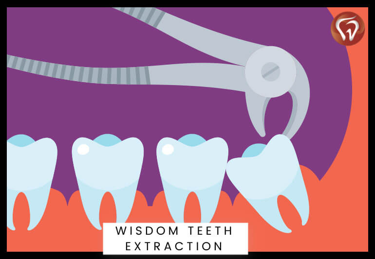 Wisdom teeth extraction