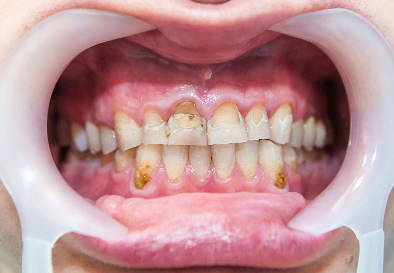 Fluorosis: Understanding the Effects of Fluoride on Dental Health