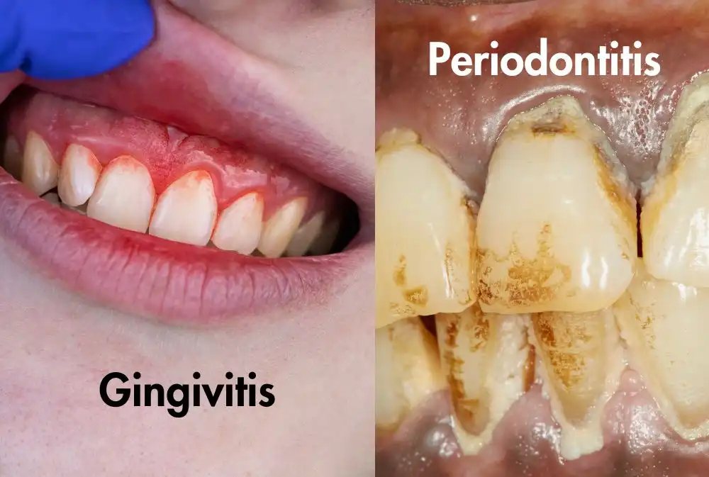 Gum Disease (Gingivitis and Periodontitis)